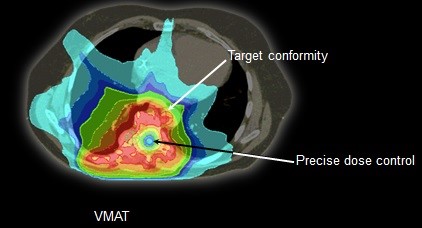IMRT VMAT IMRT VMAT
